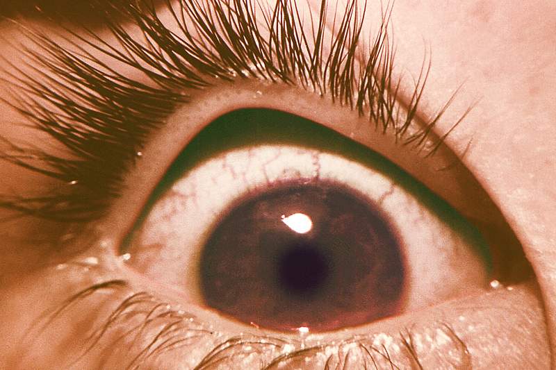 The normal right eye of a boy whose left eye was inadvertently inoculated with vaccinia virus. Original image sourced from US…