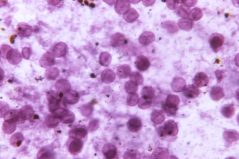 Photomicrograph of a toluidine blue stained lung tissue. A healthcare provider donning a pair of green latex gloves in order…