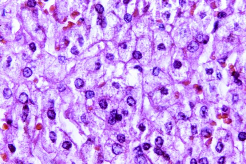 A 440X photomicrograph magnification of a hematoxylin and eosin (H&E)–stained liver tissue specimen, revealed the…