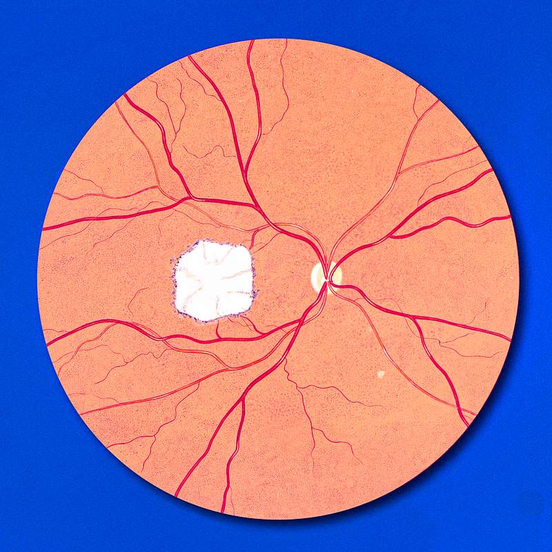 Fundoscopic view of the right eye, it's optic nerve and blood vessels supplying the retina. Original image sourced from US…