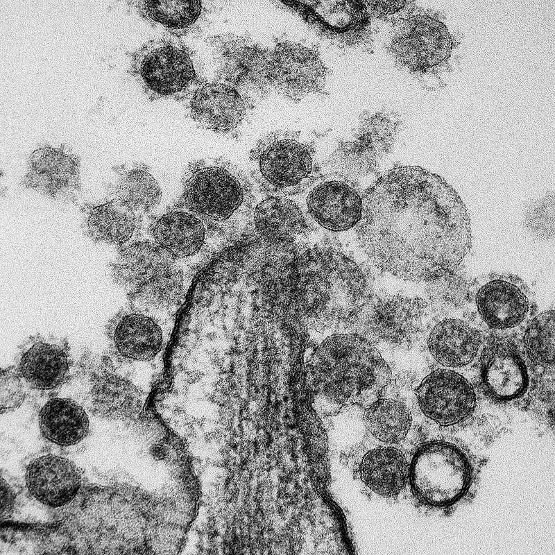 MERS Coronavirus Particles–Transmission electron micrograph of Middle East Respiratory Syndrome CoV particles found…