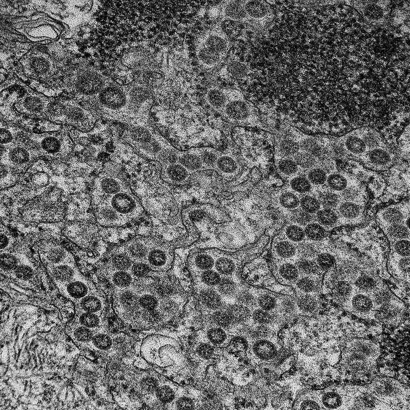 MERS Coronavirus Particles–Transmission electron micrograph of Middle East Respiratory Syndrome virusCoV particles…
