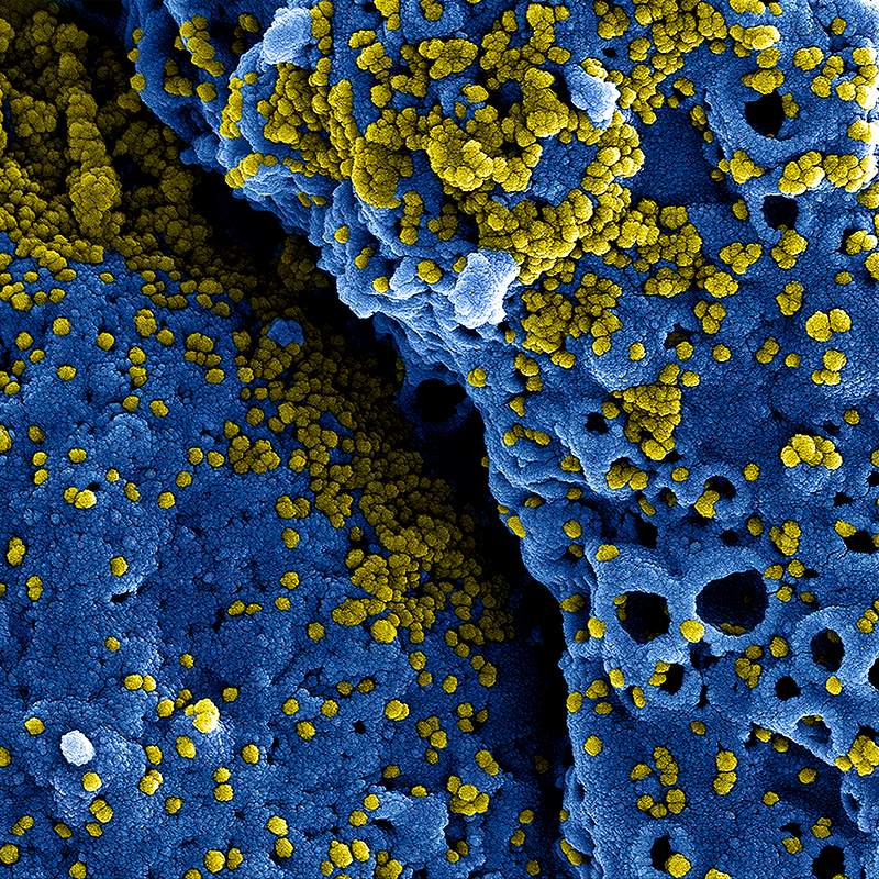MERS Coronavirus Particles–Colorized scanning electron micrograph of MERS virus particles (yellow) both budding and…