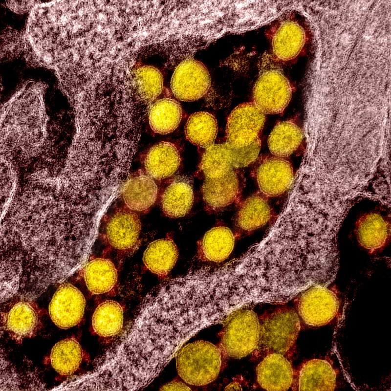 Novel Coronavirus SARS-CoV-2–Transmission electron micrograph of SARS-CoV-2 virus particles, isolated from a patient.…