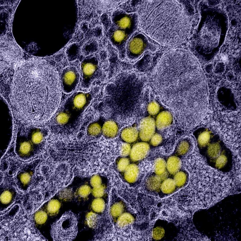 Novel Coronavirus SARS-CoV-2–Transmission electron micrograph of SARS-CoV-2 virus particles, isolated from a patient.…