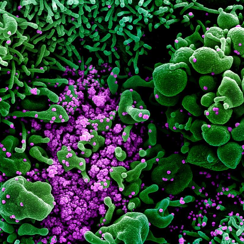 Novel Coronavirus SARS-CoV-2–Colorized scanning electron micrograph of an apoptotic cell (green) heavily infected with…