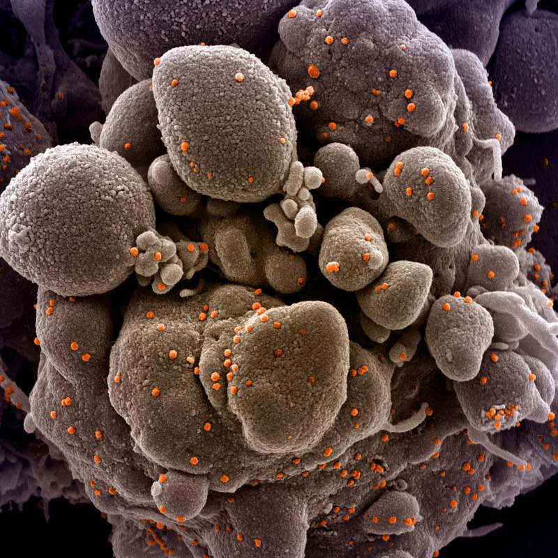 Novel Coronavirus SARS-CoV-2–Colorized scanning electron micrograph of an apoptotic cell (tan) infected with SARS-COV-2…