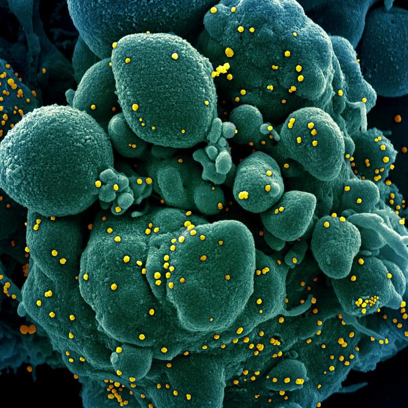 Novel Coronavirus SARS-CoV-2–Colorized scanning electron micrograph of an apoptotic cell (green) infected with SARS-COV…