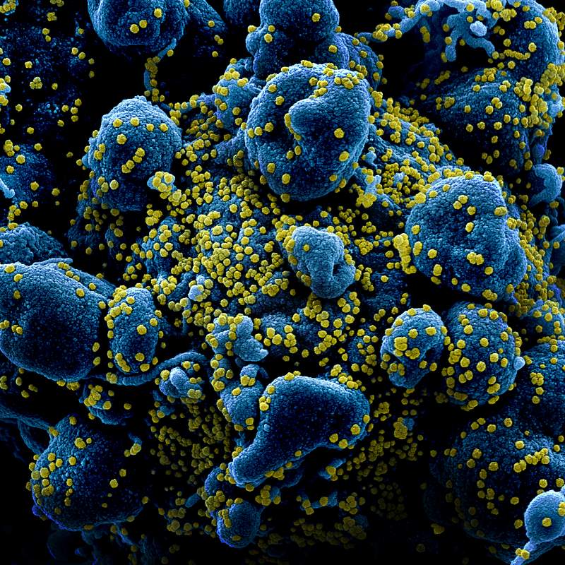 Novel Coronavirus SARS-CoV-2–Colorized scanning electron micrograph of an apoptotic cell (blue) heavily infected with…