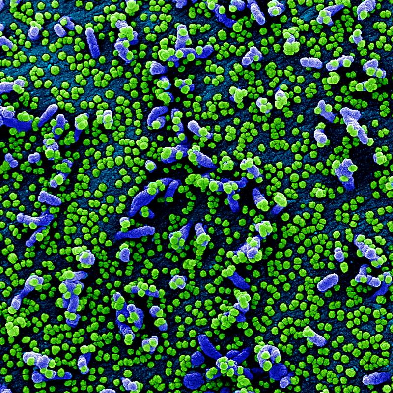 Novel Coronavirus SARS-CoV-2–Colorized scanning electron micrograph of a VERO E6 cell (blue) heavily infected with SARS…